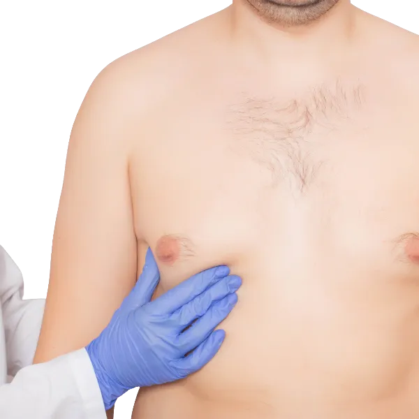 correccion ginecomastia - cirugía de mama con la doctora silvia rojas
