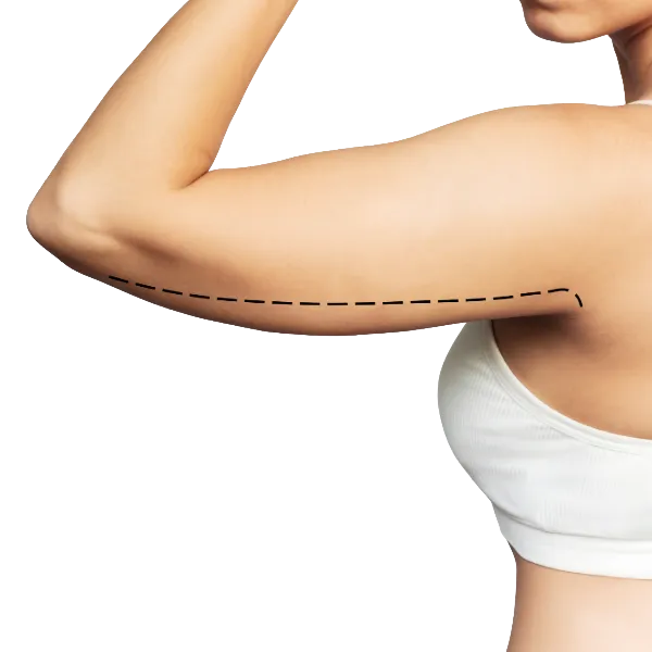 lifting brazos - cirugía de mama con la doctora silvia rojas