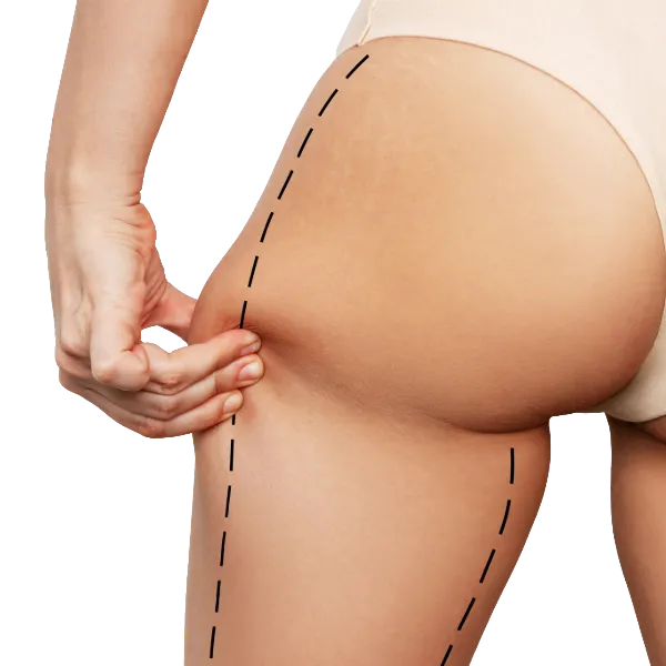 lifting muslos - cirugía de mama con la doctora silvia rojas